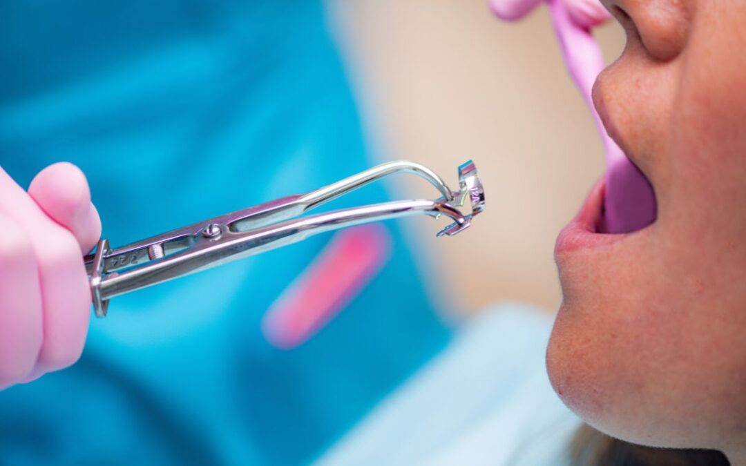 Experiencing Dry Socket After Wisdom Teeth Extraction? Here’s What to Do