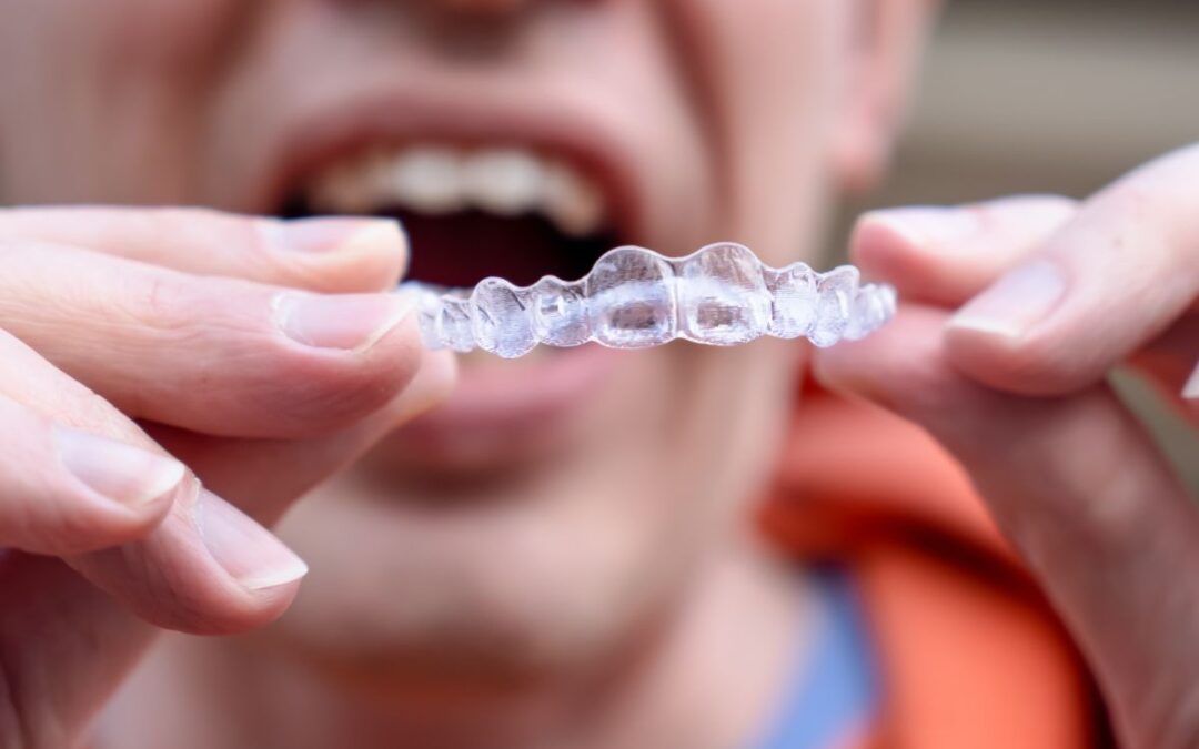 invisalign aligners