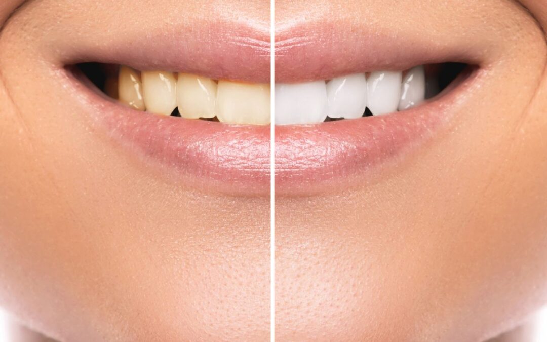 Get Brighter Teeth: The Benefits of Visiting a Cosmetic Dentist for Teeth Whitening