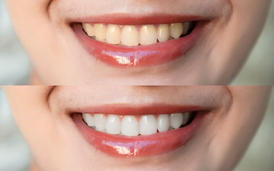 Top 5 Benefits of Professional Teeth Whitening