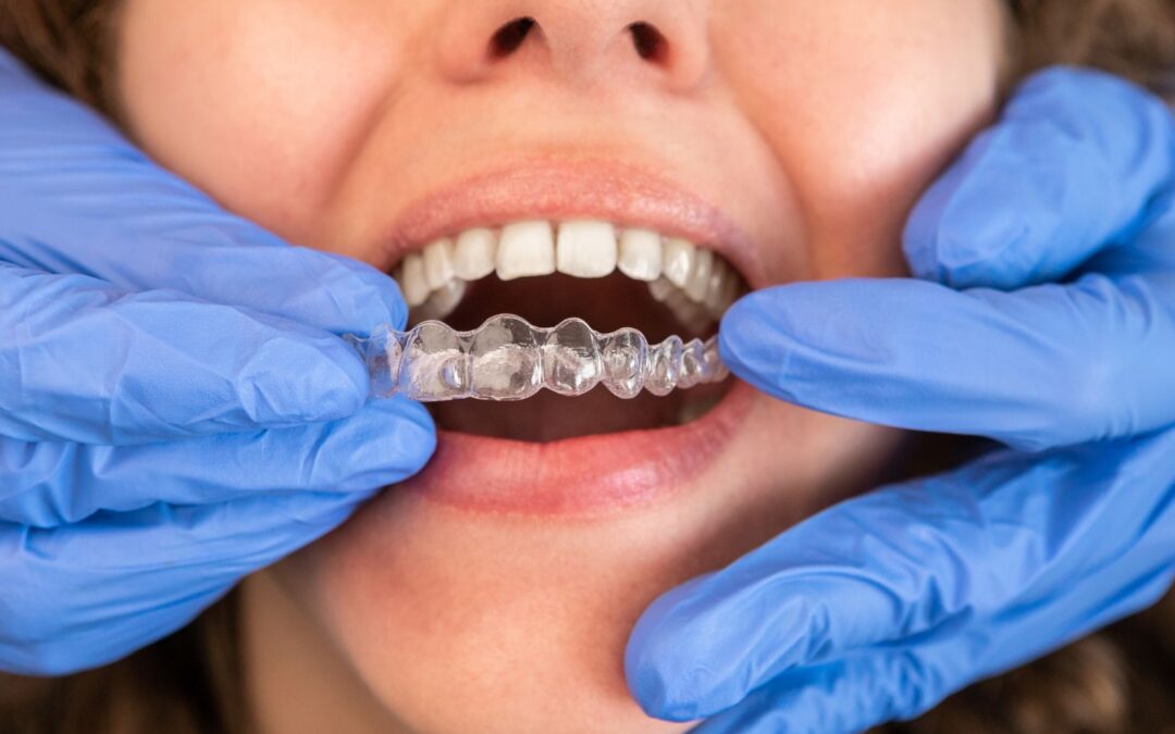 How to Clean Invisalign? Tips, Prevention, and More – Healthline