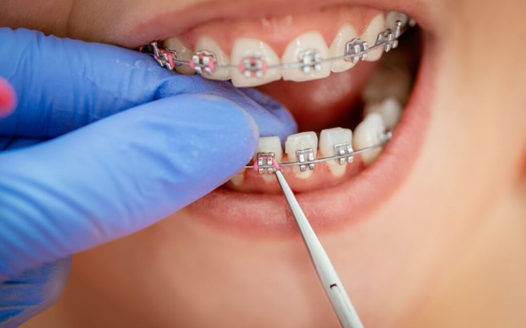 How to Put Braces Wire Back in Place?