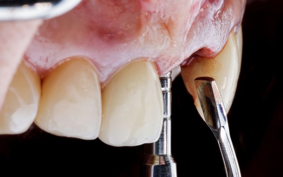 How Can I Slow Down Dental Bone Loss Effectively?