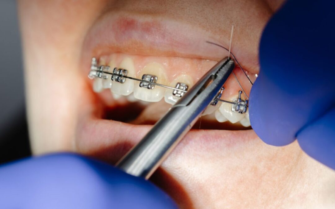 Why More Adults Are Choosing Orthodontics?