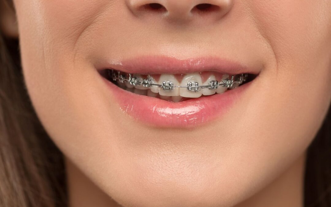 Teeth Relapse After Braces: What Happens and How to Prevent It?