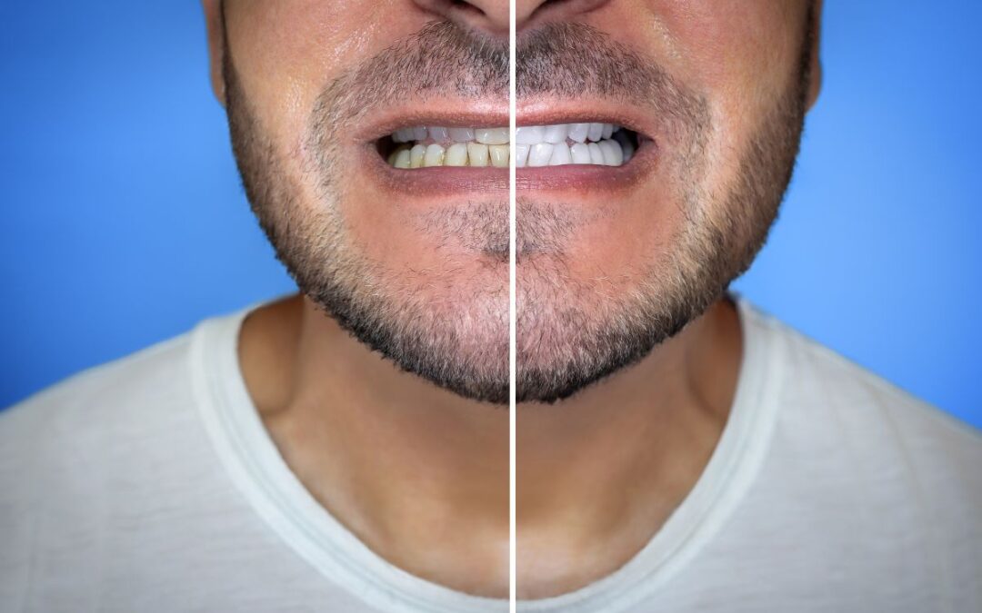 Why Do Teeth Turn Yellow? Causes and Whitening Solutions