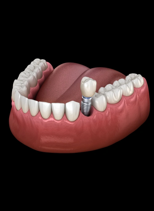 img-dental-implants-Our-Dental-Implant-Process dentist office conte dentistry red bank nj services invisalign and invisalign teen image