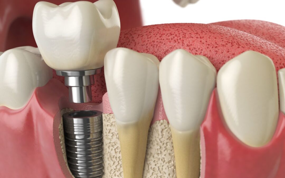 What Are the Benefits of Dental Implants Over Traditional Methods?