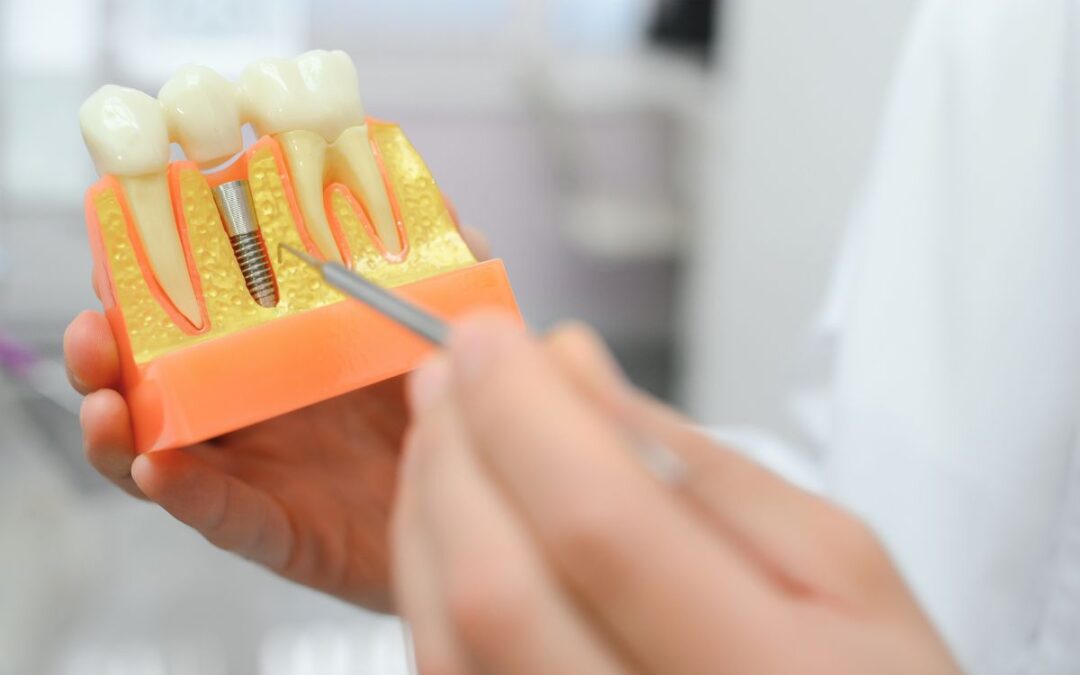 How to Deal With Metallic Taste After Dental Implants?