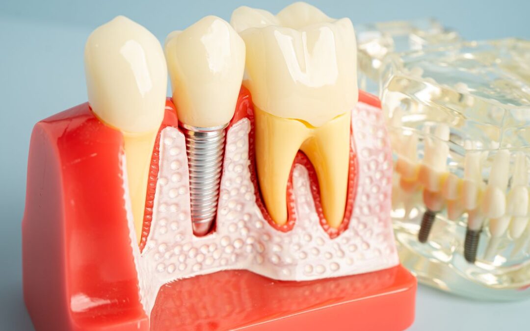 Can Bone Loss Stop You From Getting Dental Implants?