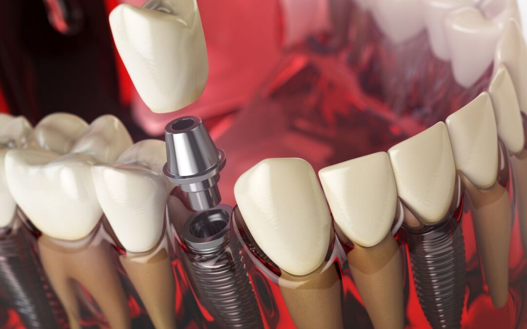 Am I Too Old for Dental Implants? Busting Age Myths and Health Misconceptions