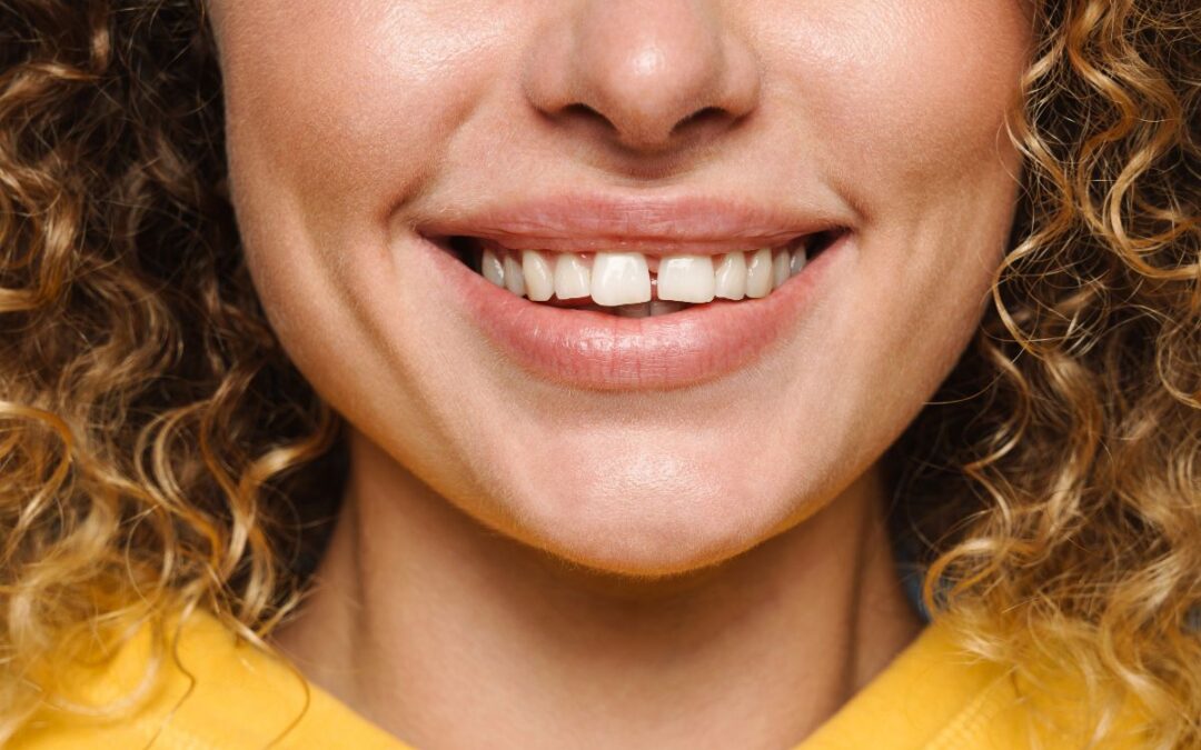 Gaps between teeths